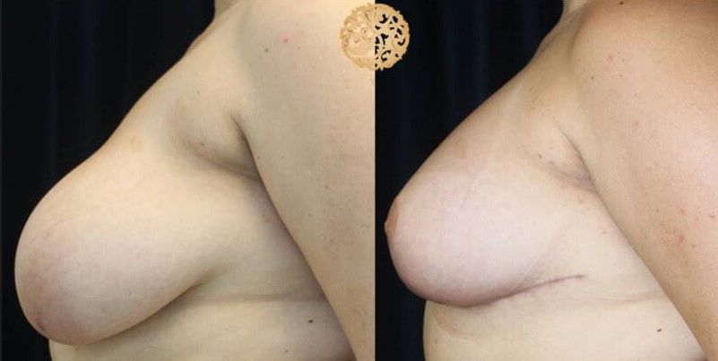 Breast Reduction Before & After
