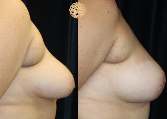 Breast Reduction Before & After