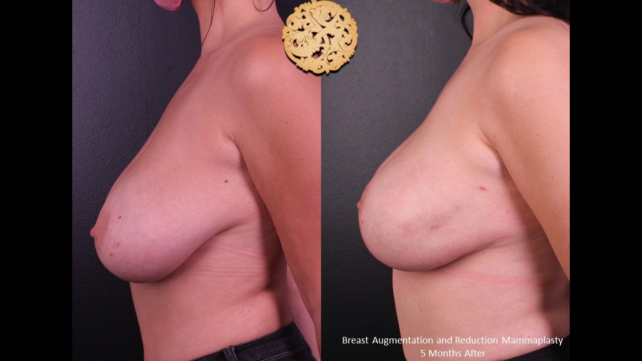 Breast Reduction Before & After