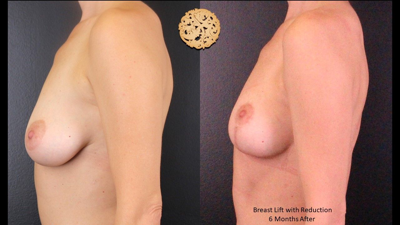 Breast Reduction Before & After