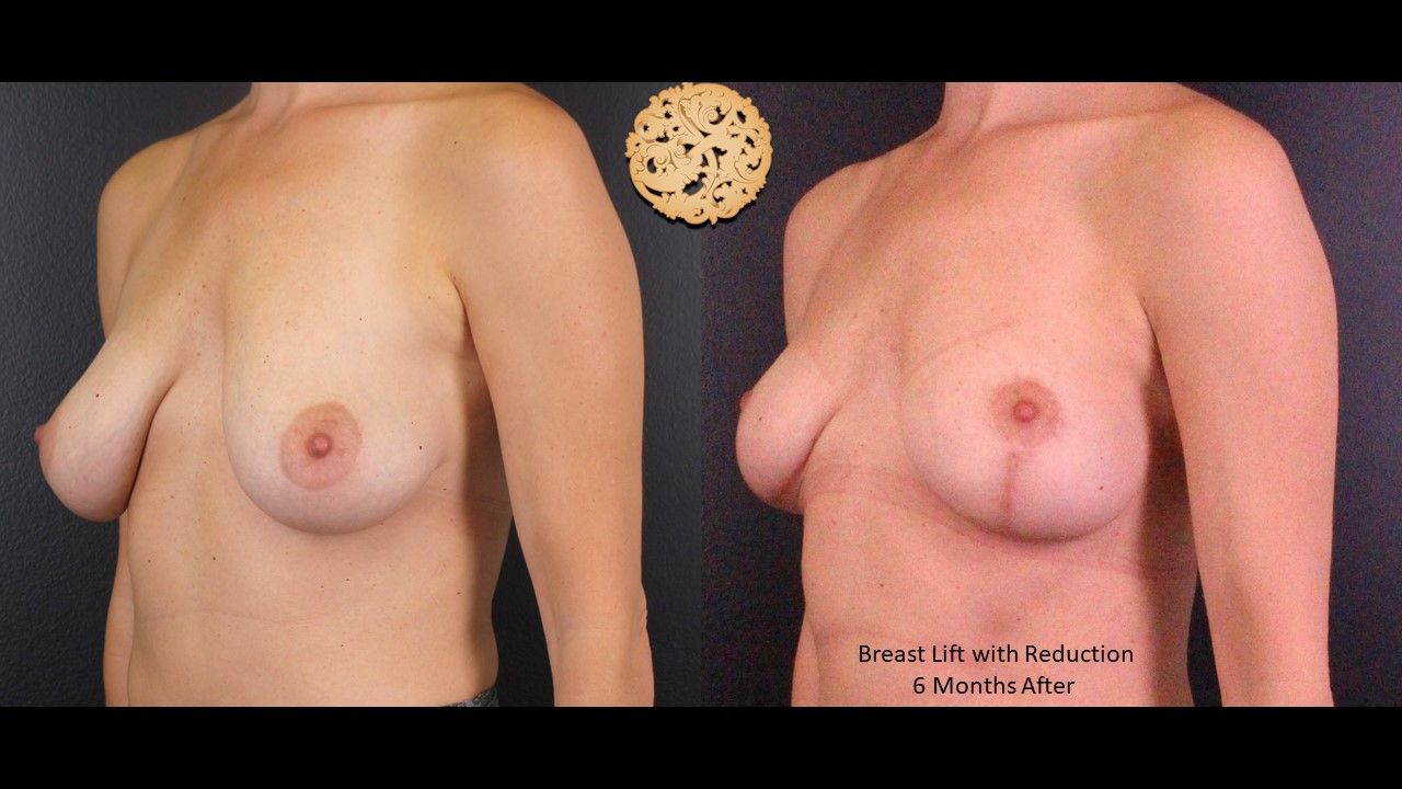 Breast Reduction Before & After