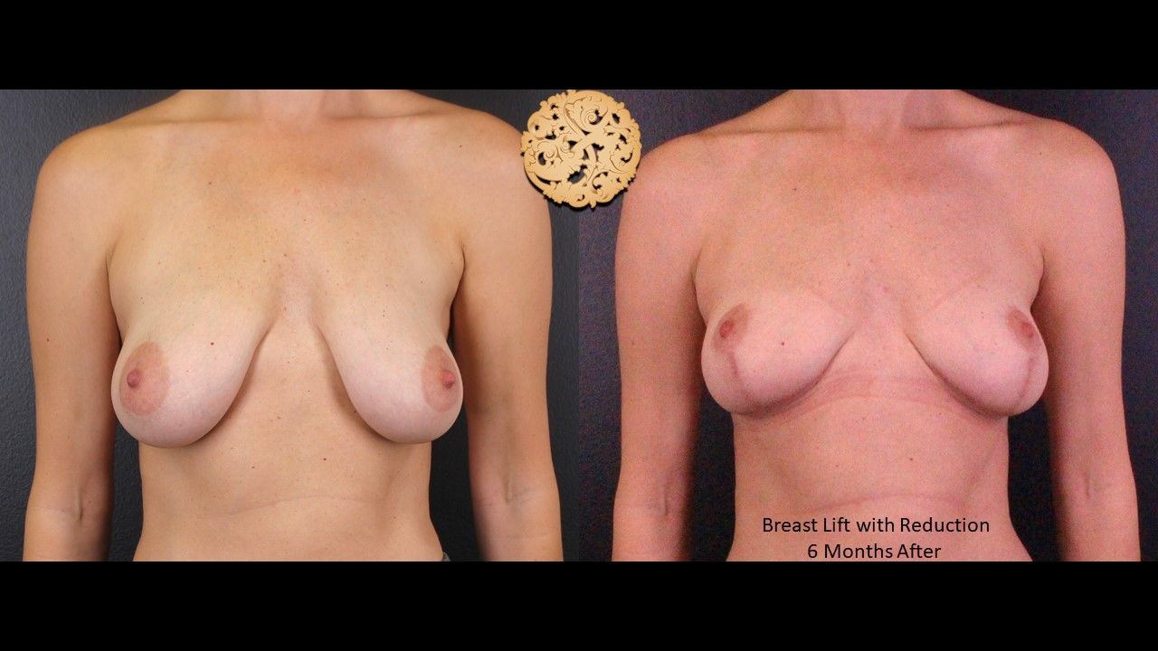 Breast Reduction Before & After