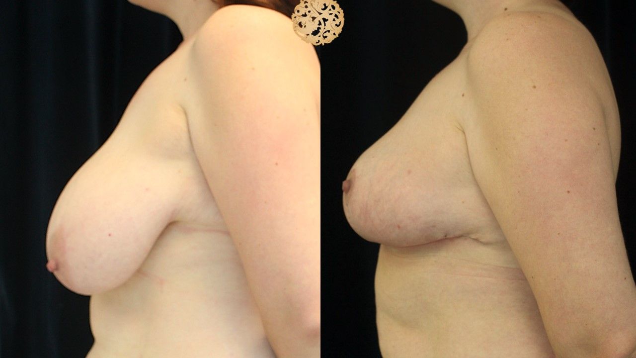Breast Reduction Before & After
