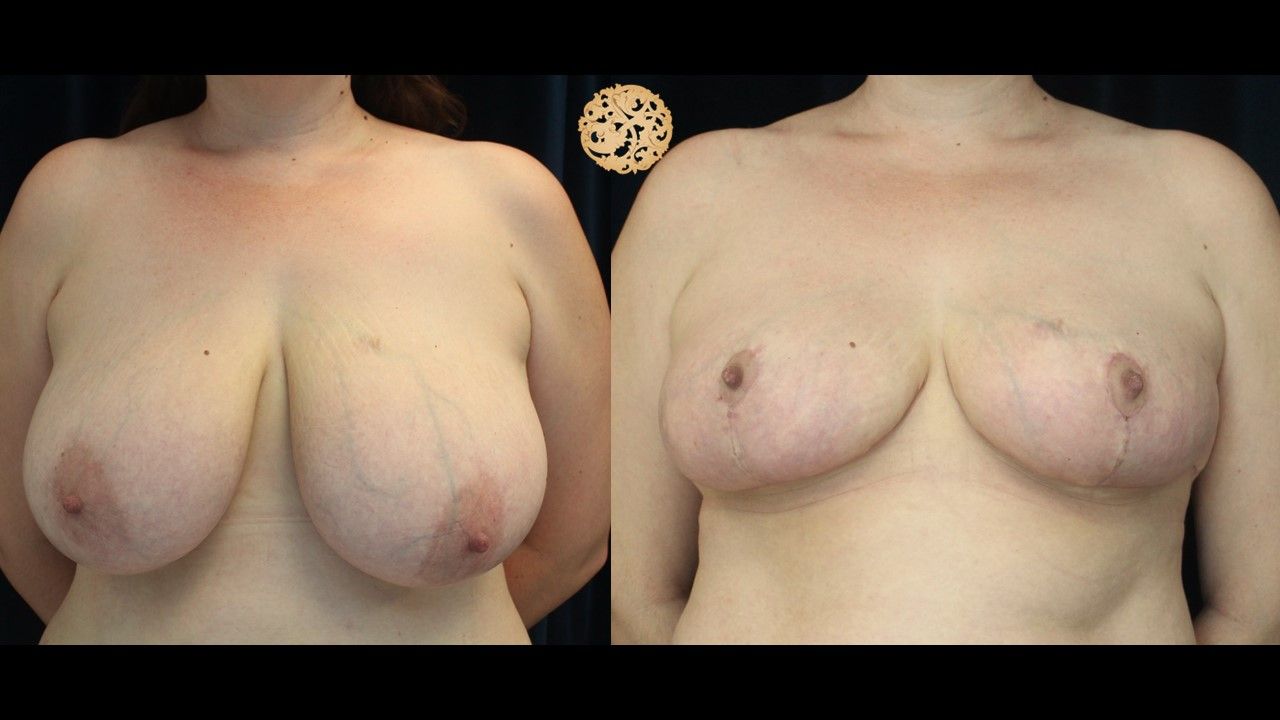 Breast Reduction Before & After