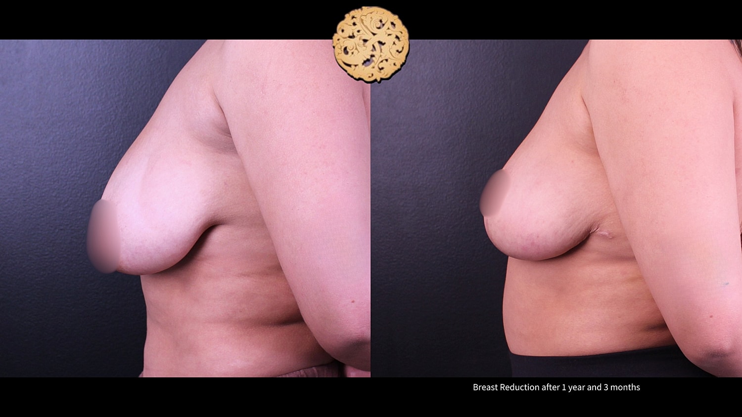 Breast Reduction Before & After