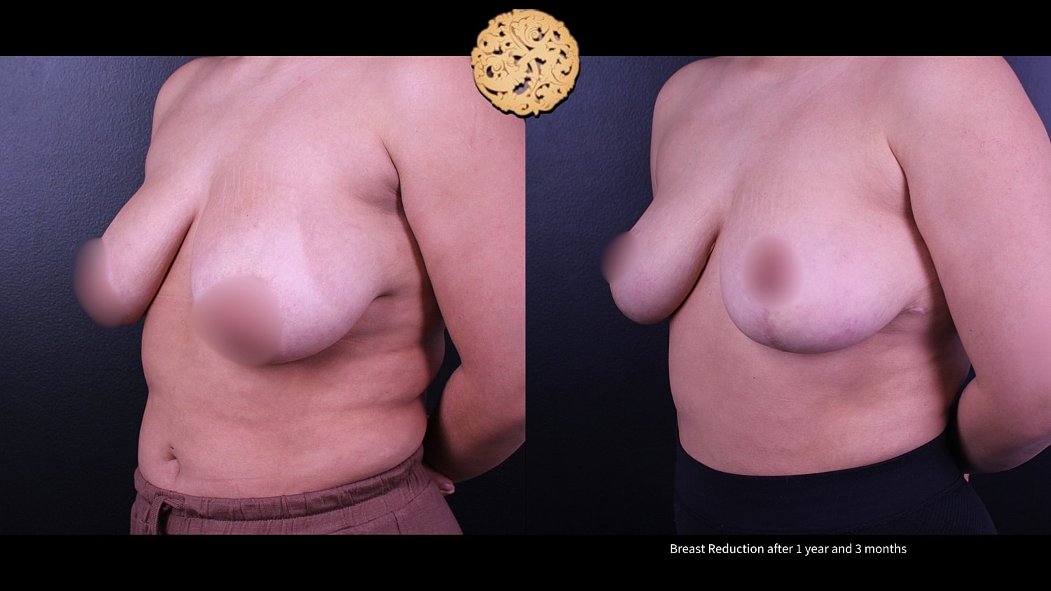 Breast Reduction Before & After