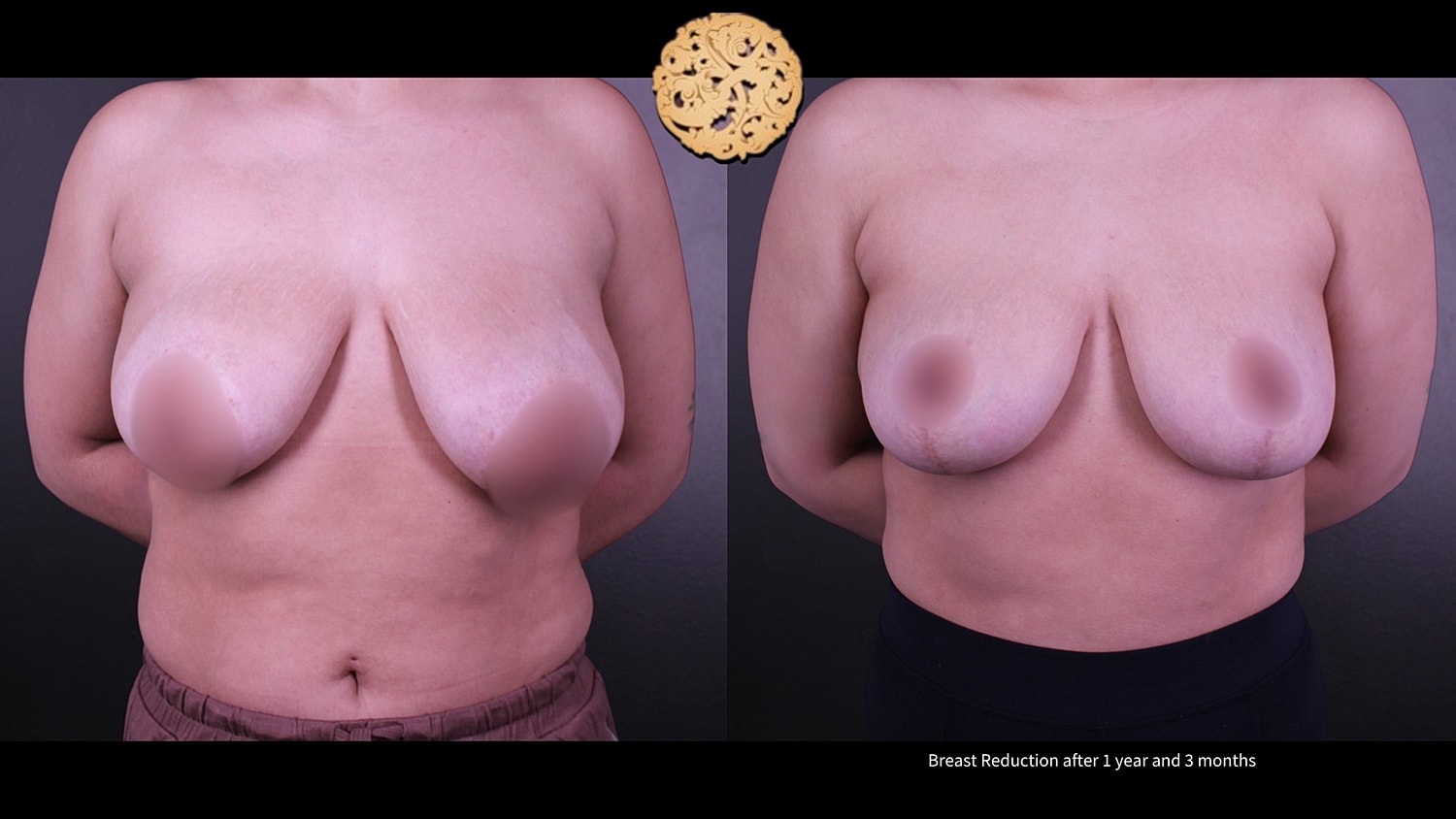 Breast Reduction Before & After