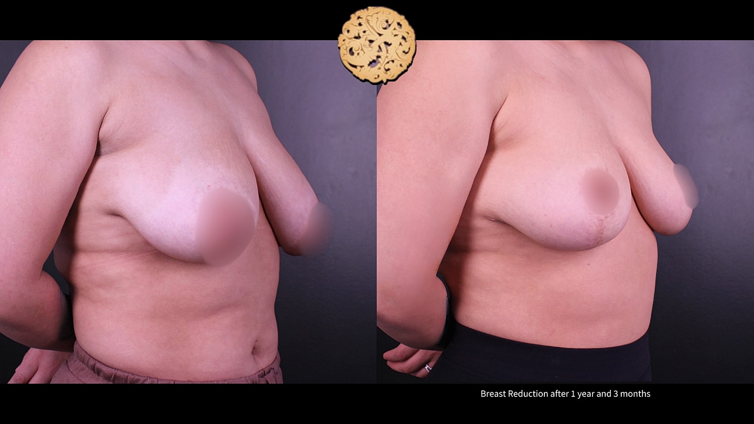 Breast Reduction Before & After