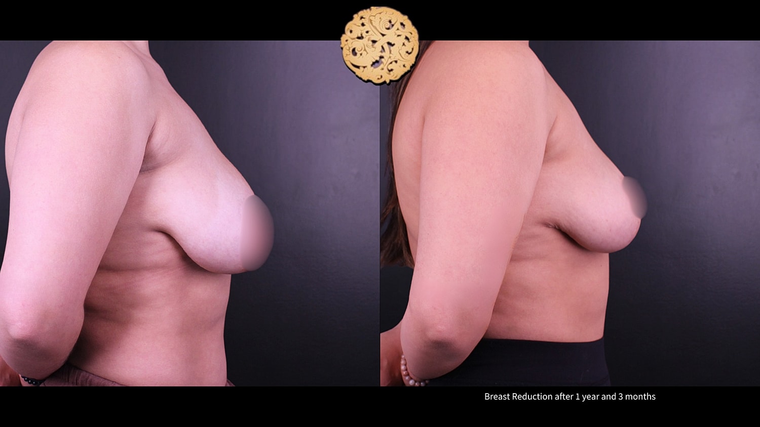 Breast Reduction Before & After