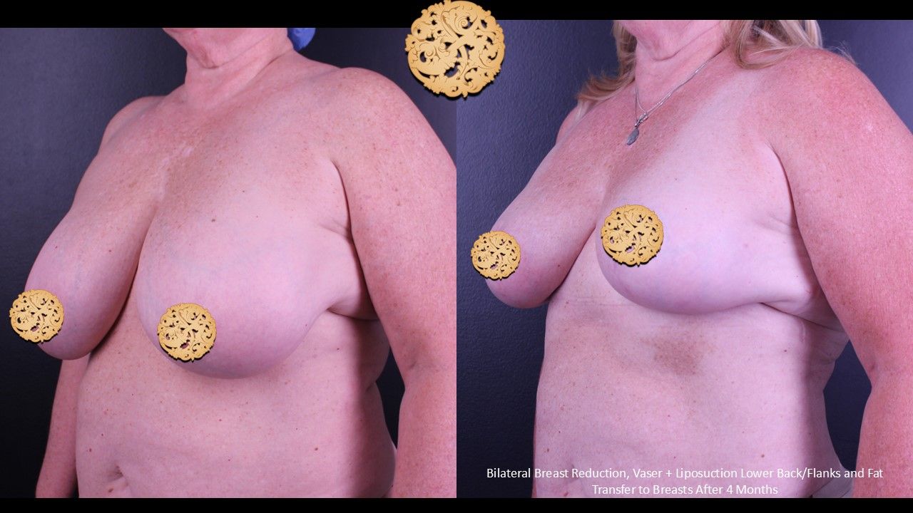Breast Reduction Before & After