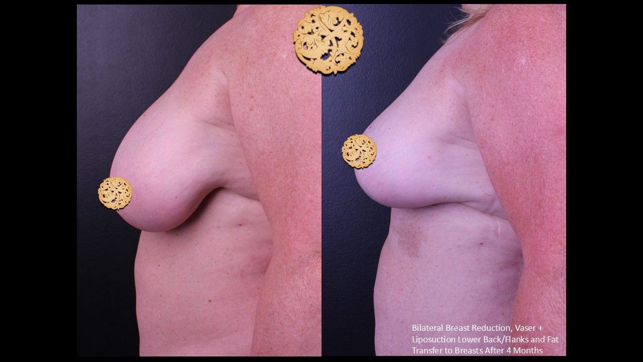 Breast Reduction Before & After