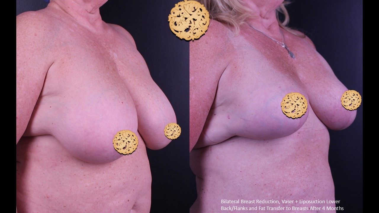 Breast Reduction Before & After