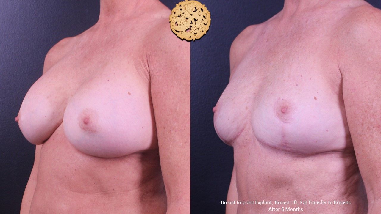 Breast Lift Before & After