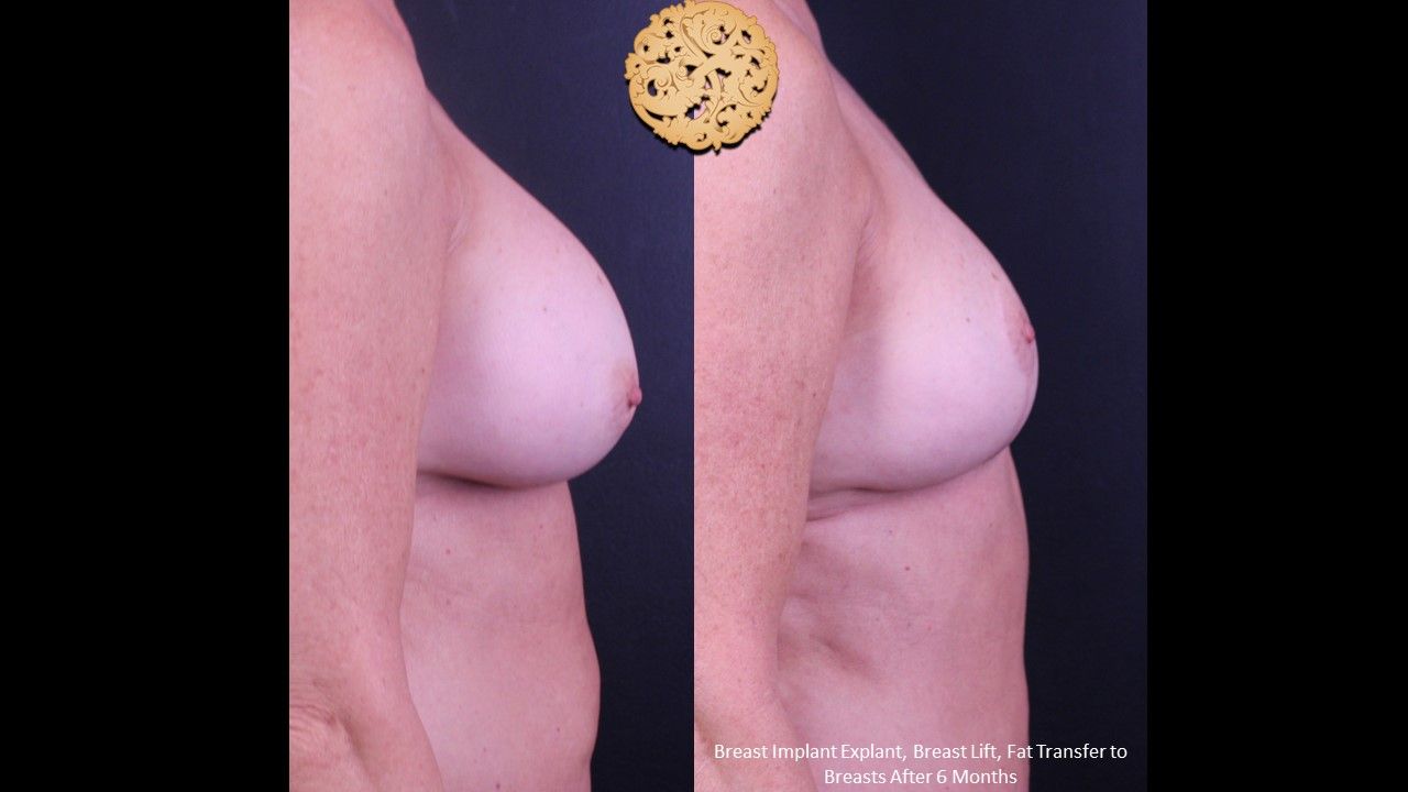 Breast Lift Before & After
