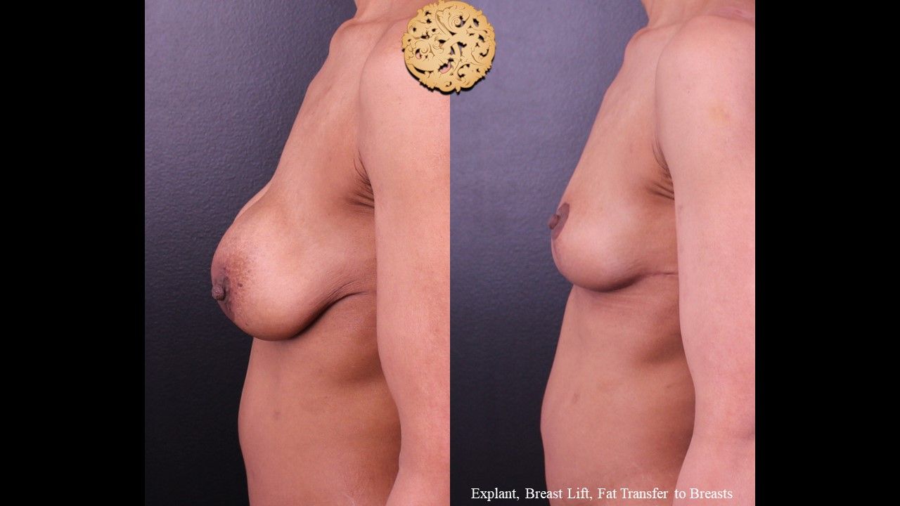 Breast Lift Before & After