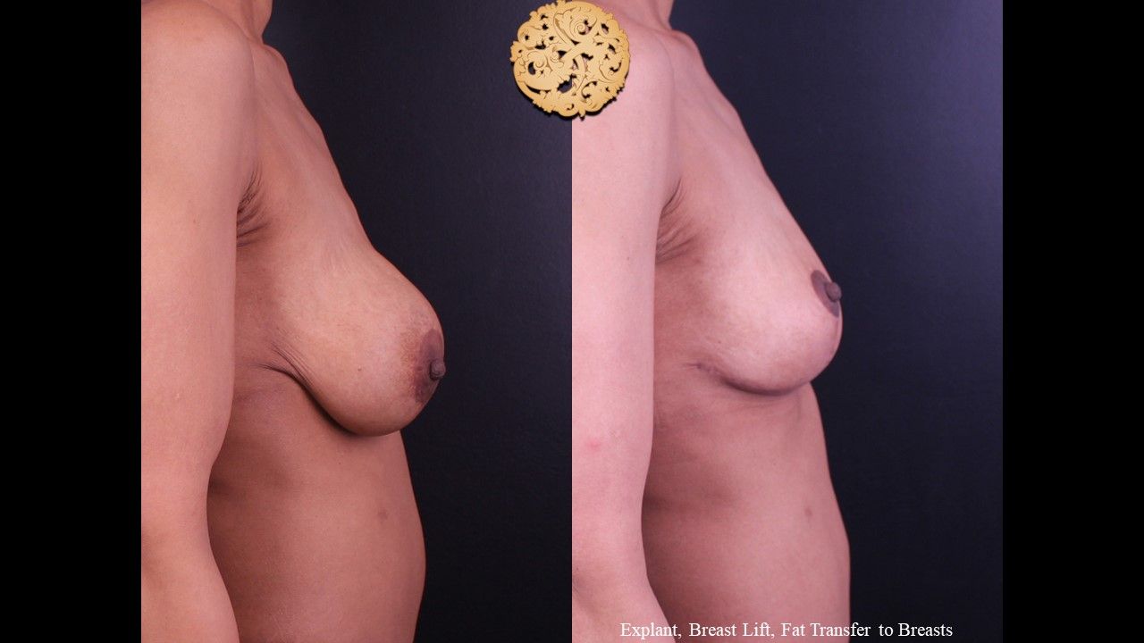 Breast Lift Before & After