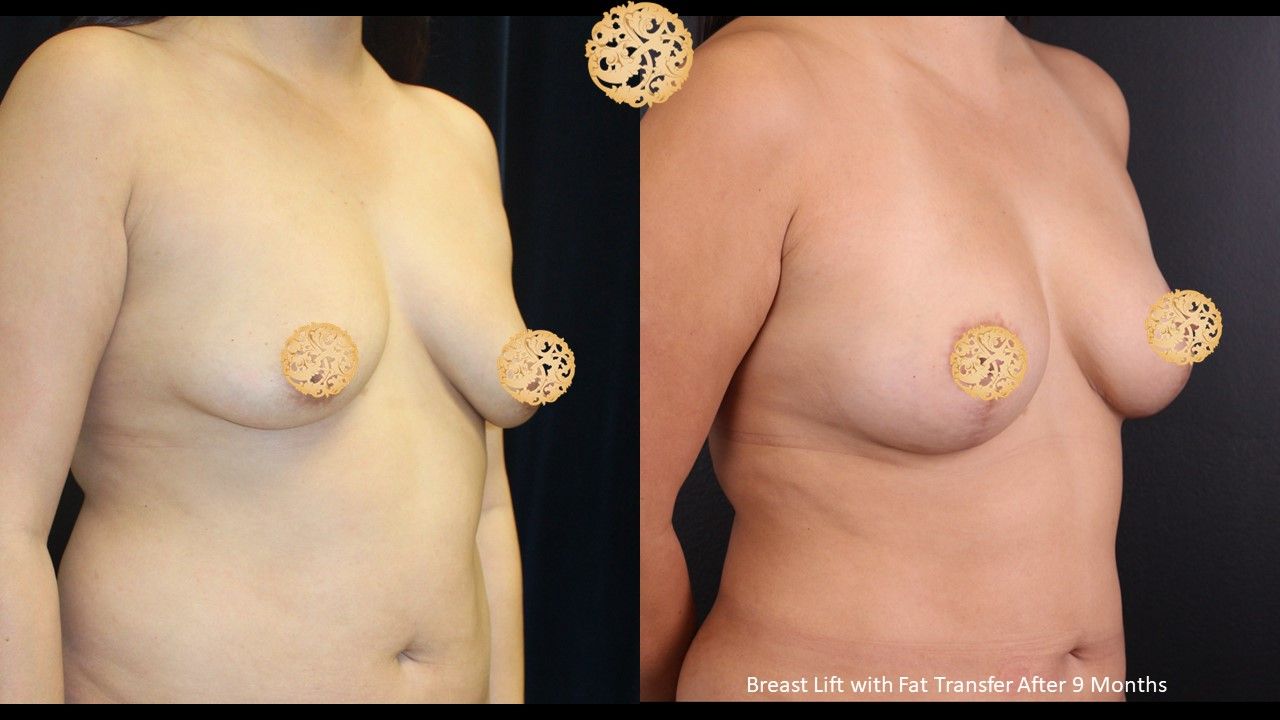 Breast Lift Before & After