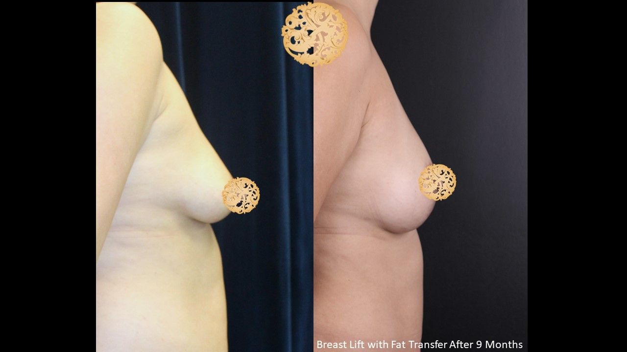 Breast Lift Before & After