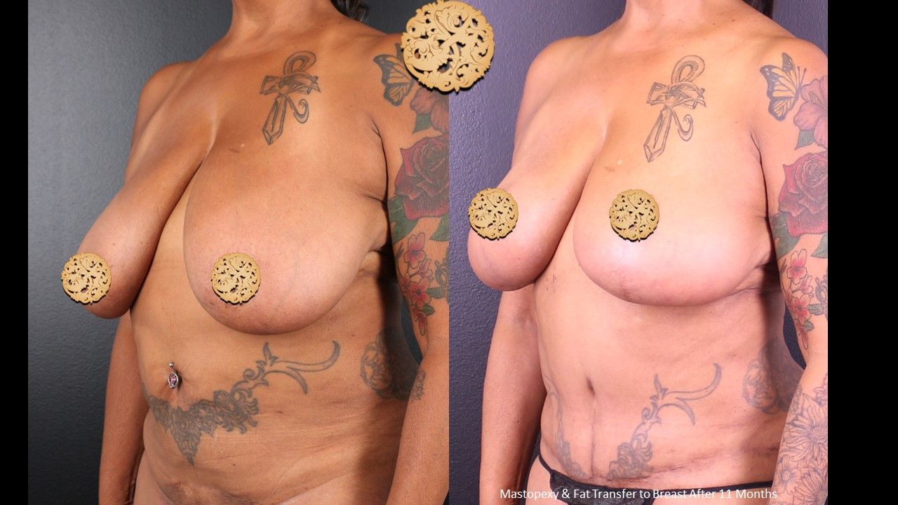 Breast Lift Before & After