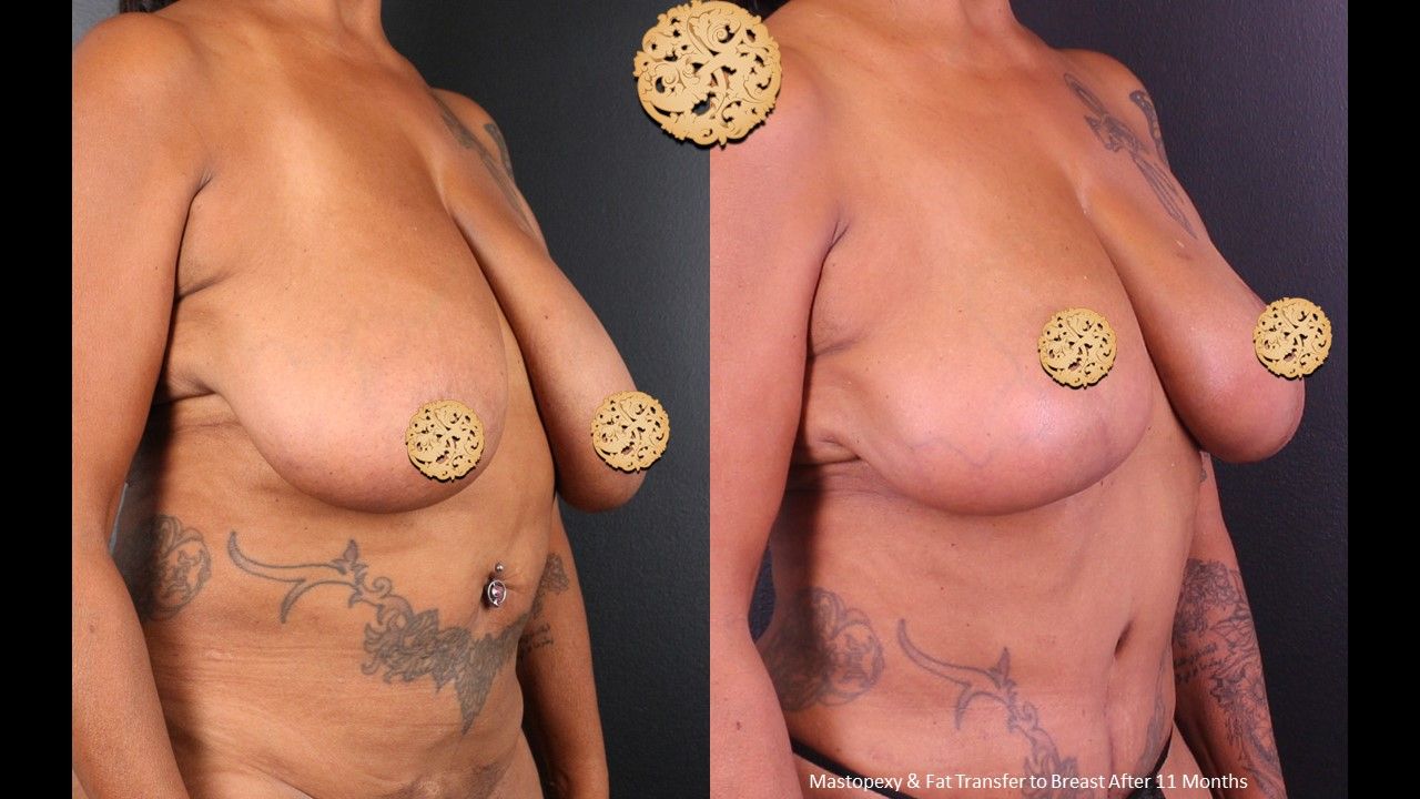 Breast Lift Before & After