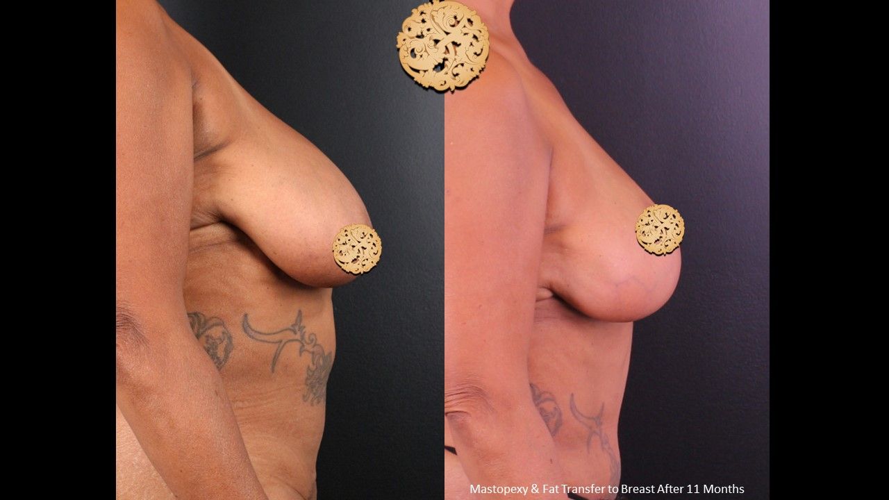 Breast Lift Before & After