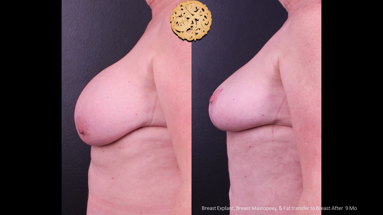 Breast Lift Before & After