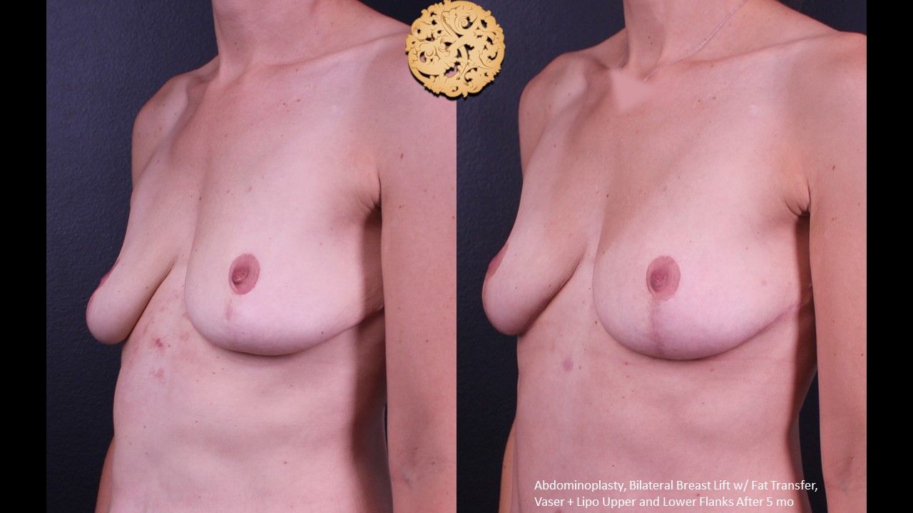 Breast Lift Before & After