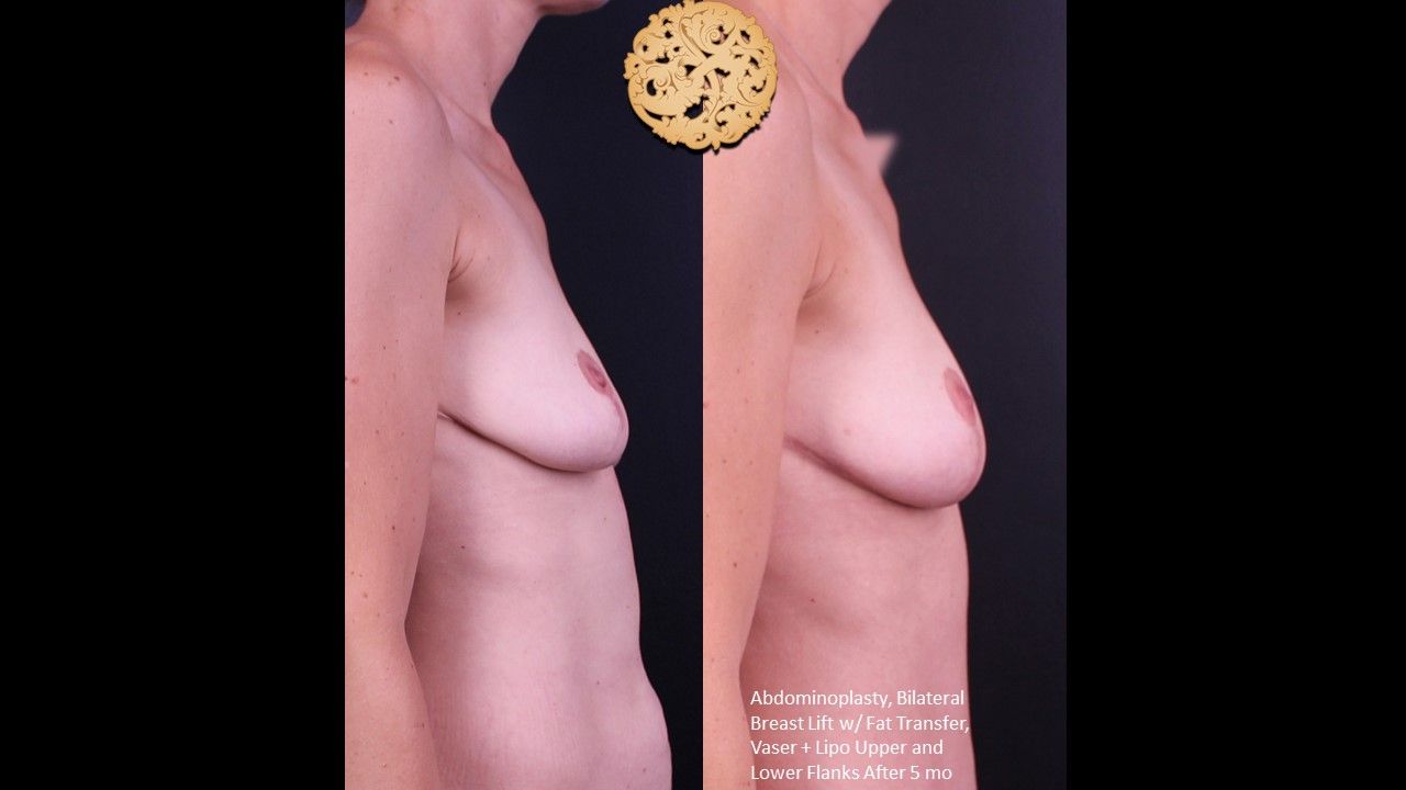 Breast Lift Before & After