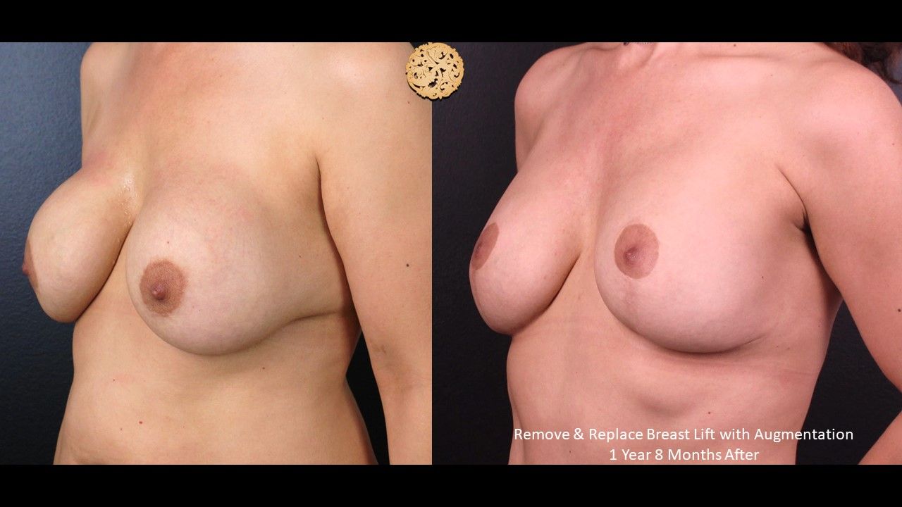 Breast Lift Before & After