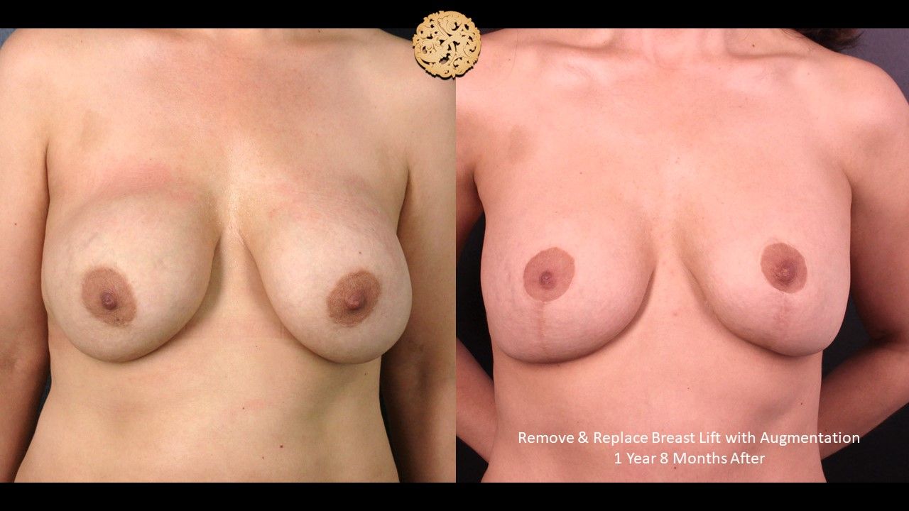 Breast Lift Before & After
