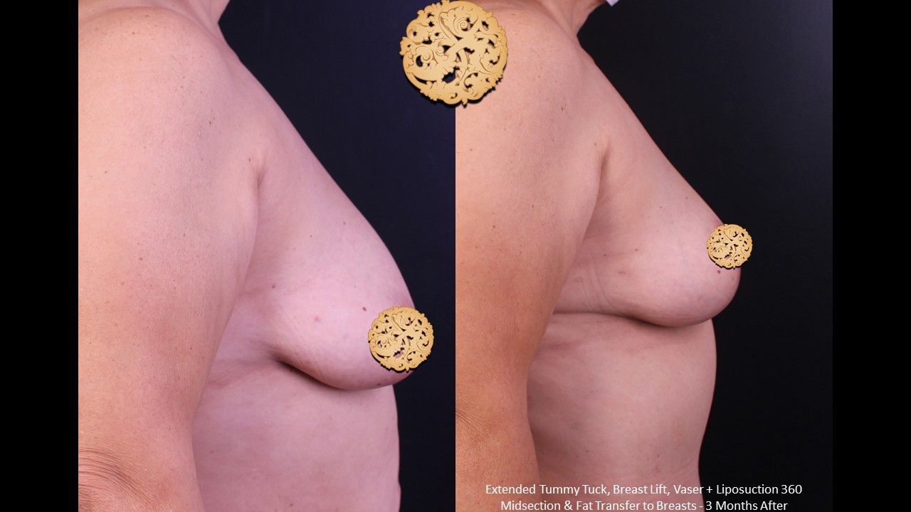 Breast Lift Before & After
