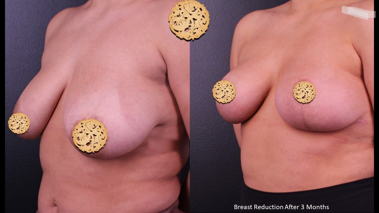Breast Lift Before & After