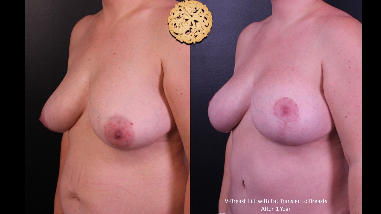 Breast Lift Before & After