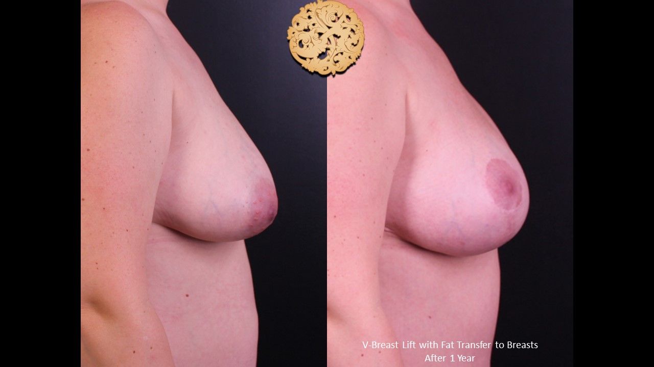 Breast Lift Before & After