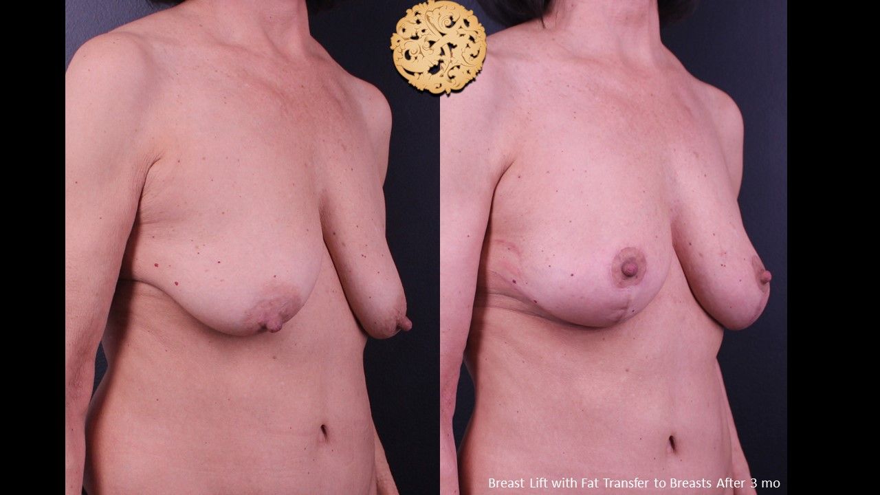 Breast Lift Before & After
