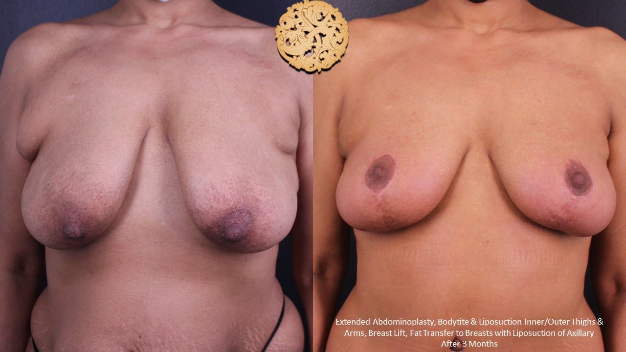 Breast Lift Before & After