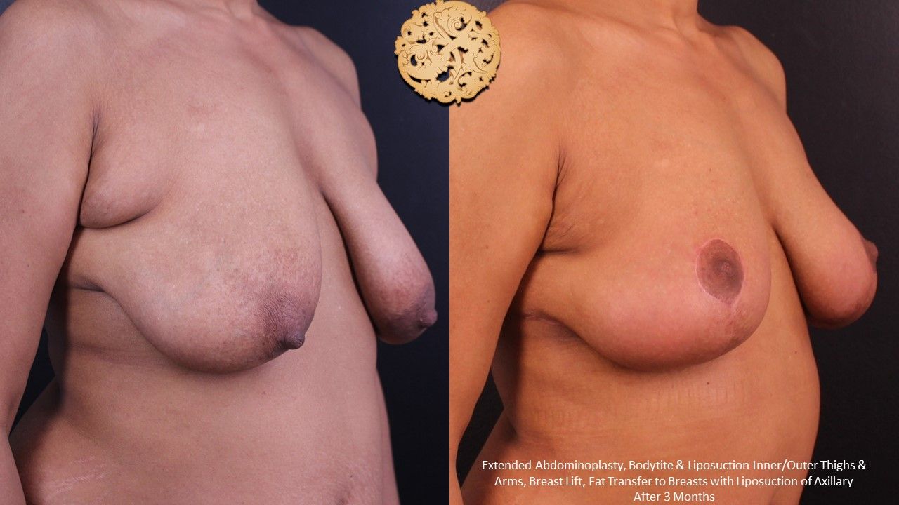 Breast Lift Before & After