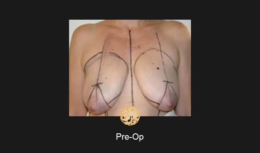 Breast Lift Before & After
