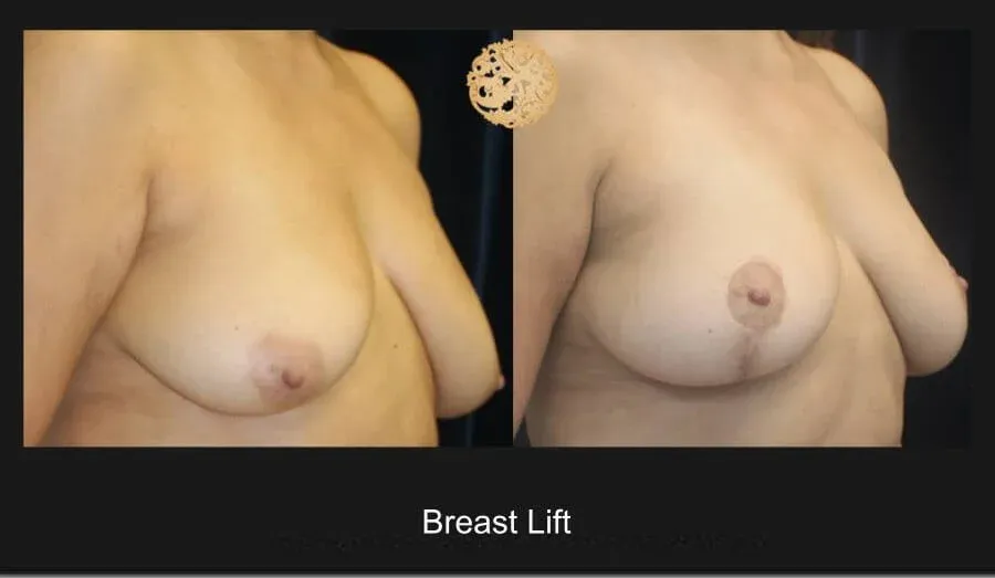 Breast Lift Before & After