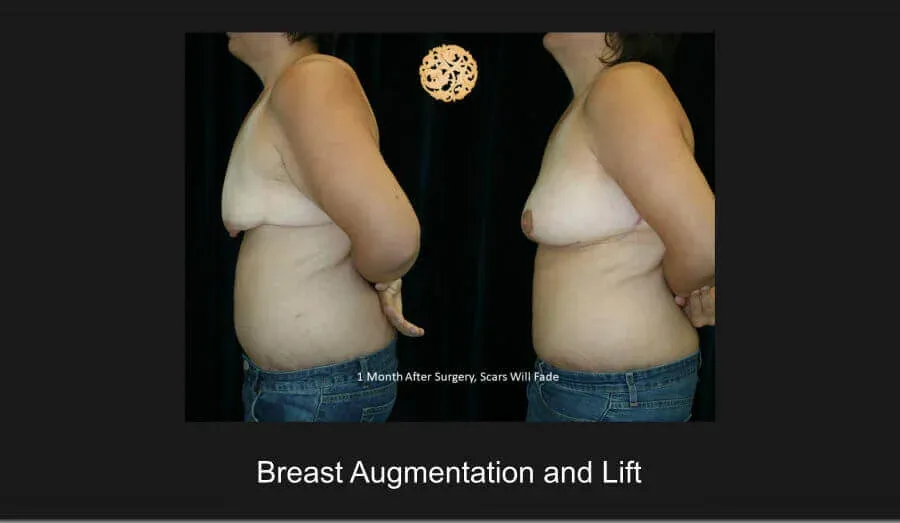 Breast Lift Before & After