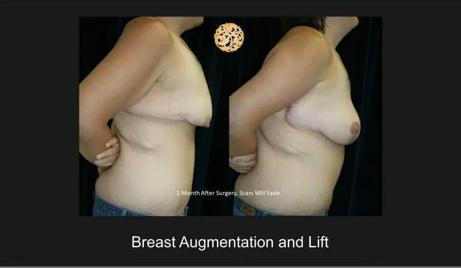 Breast Lift Before & After
