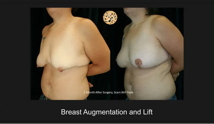 Breast Lift Before & After