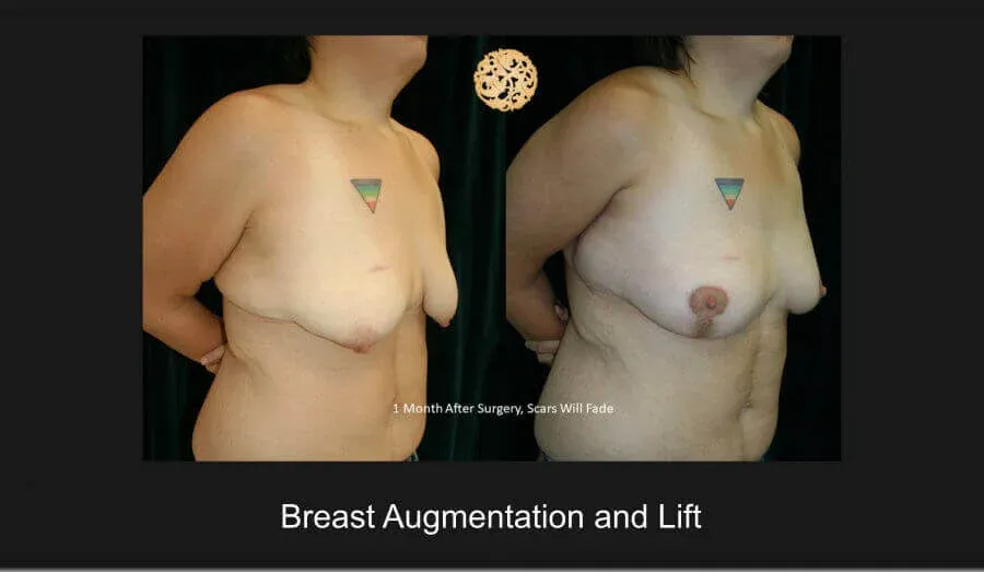 Breast Lift Before & After