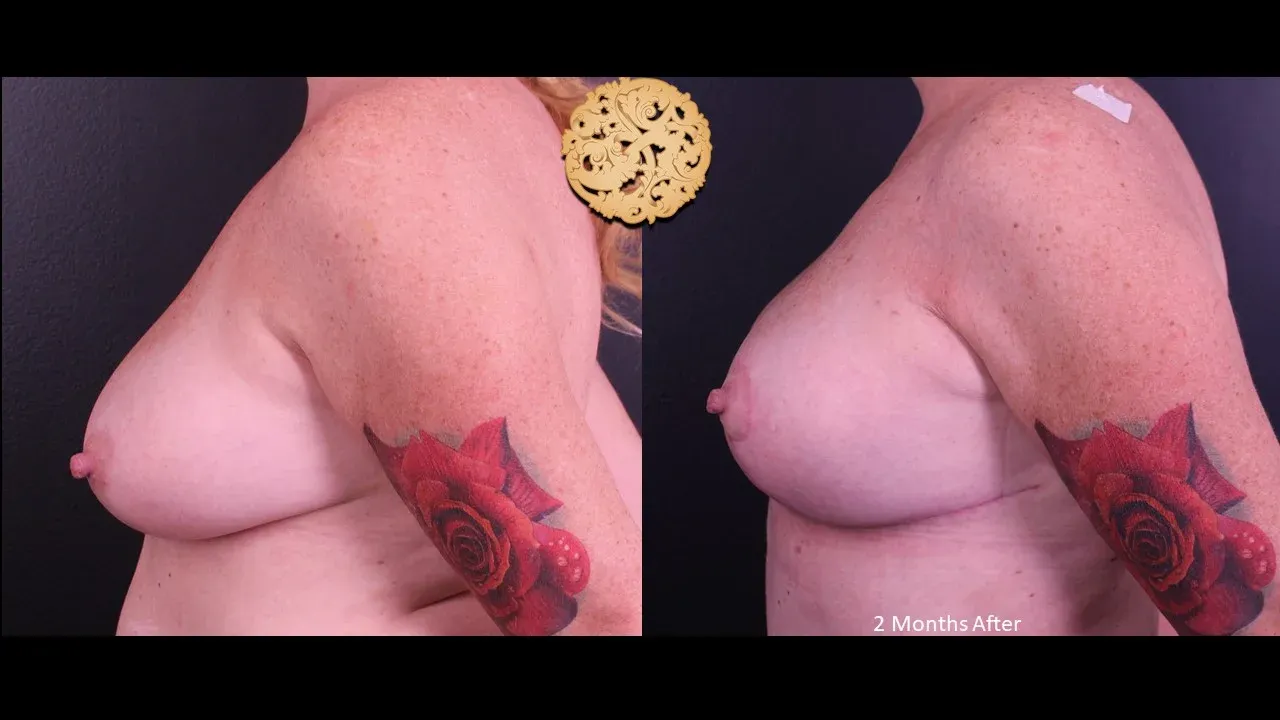Breast Lift Before & After