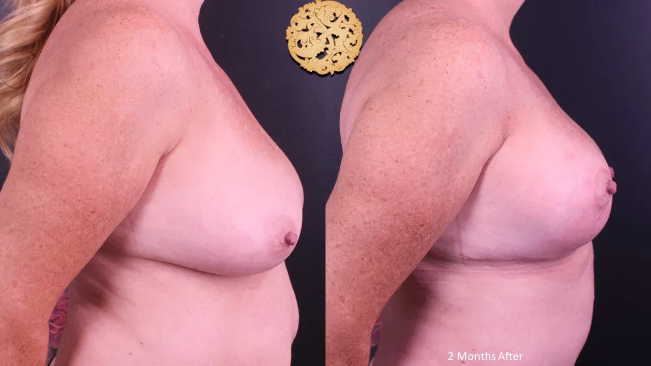 Breast Lift Before & After