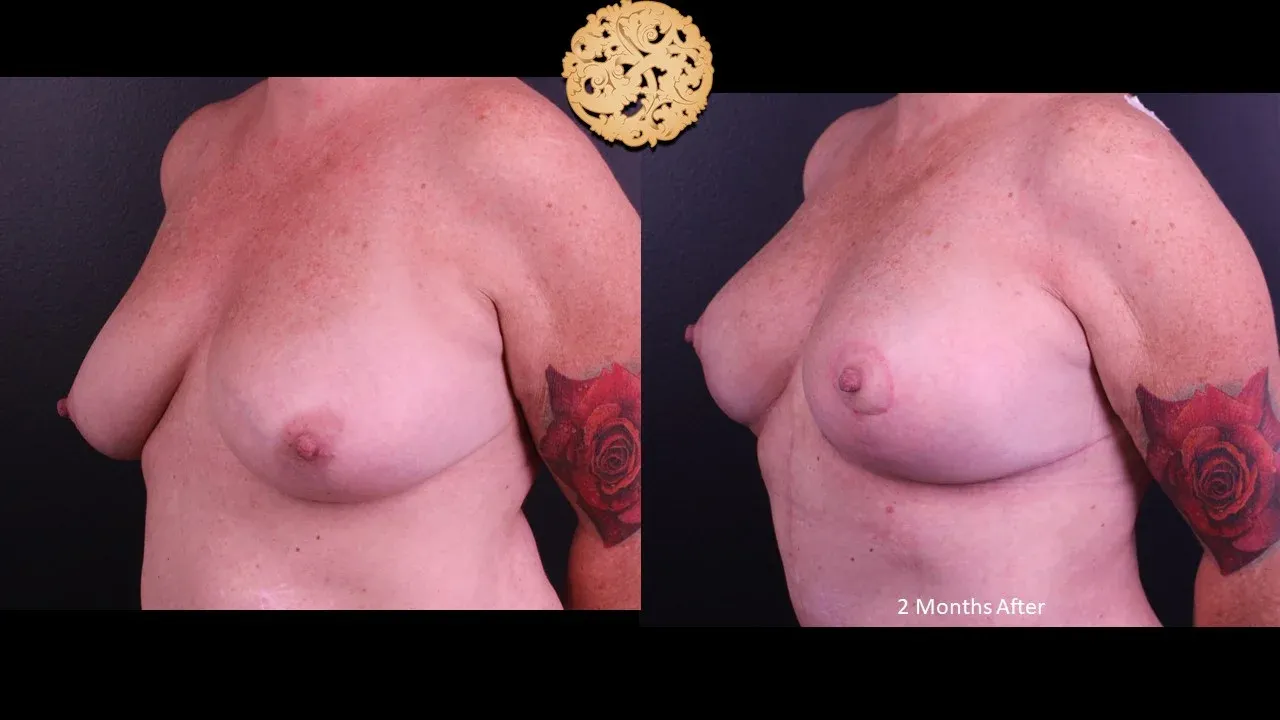 Breast Lift Before & After