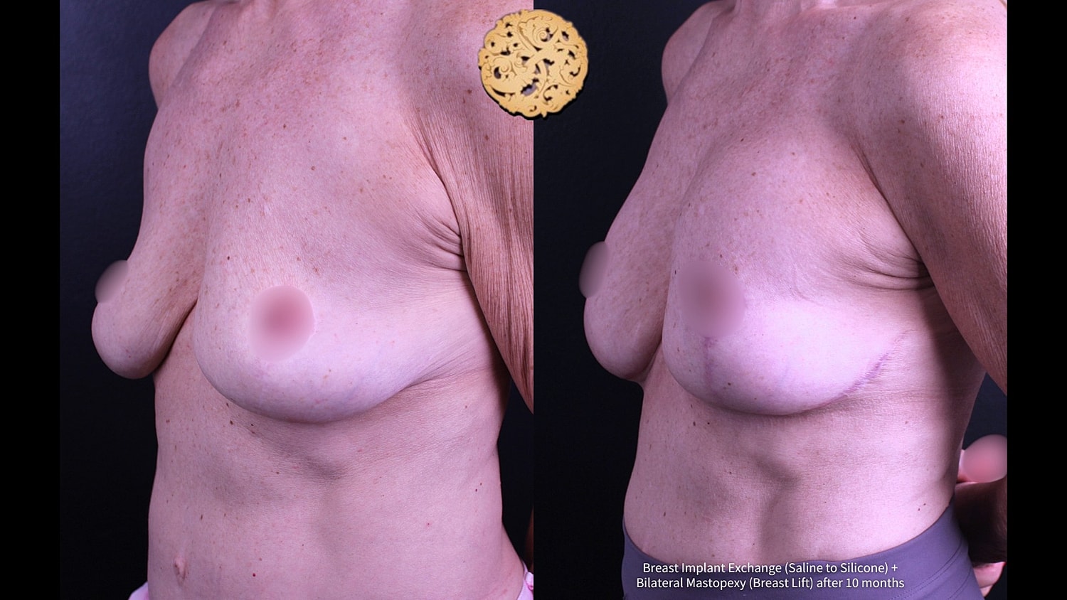 Before and after breast surgery comparison.
