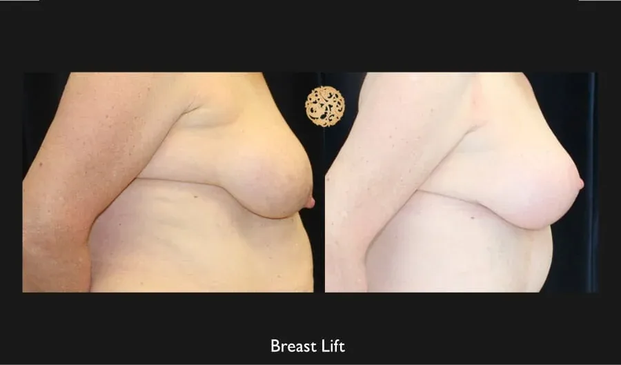 Breast Lift Before & After