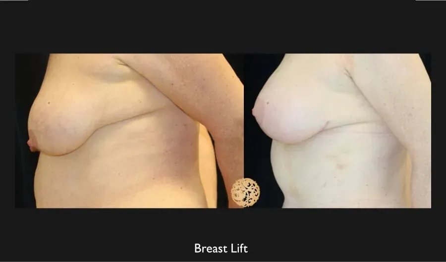 Breast Lift Before & After