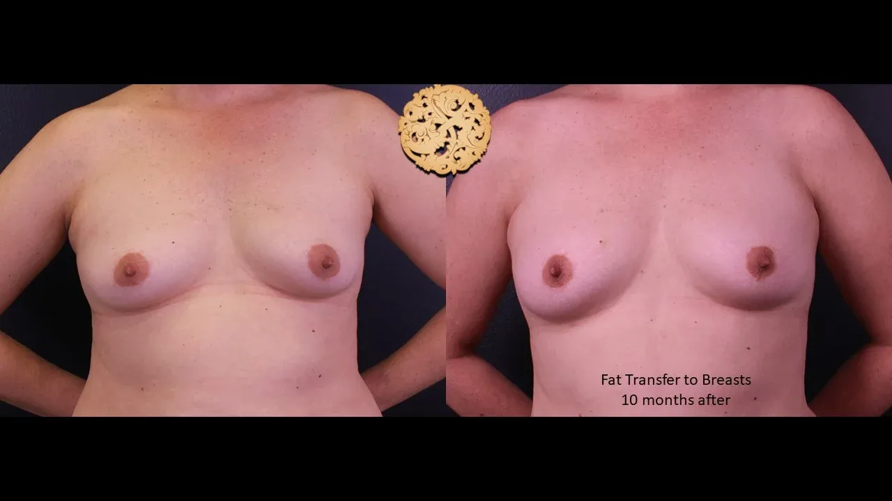 Breast Lift Before & After